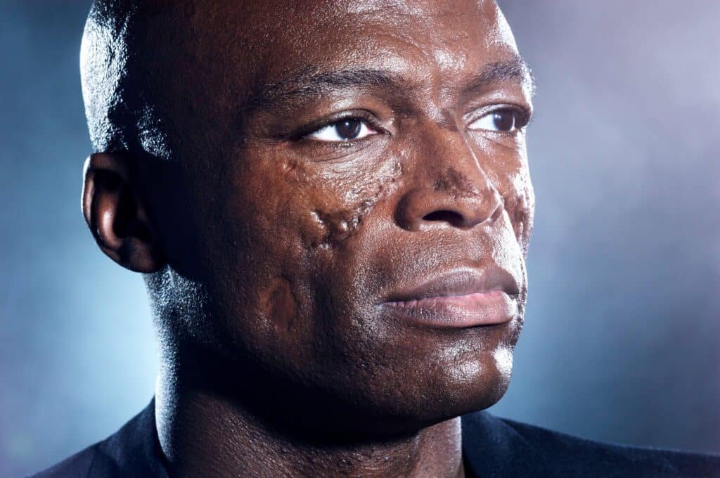 Close-up of a person with visible facial scars, looking thoughtful against a soft, blurred background.